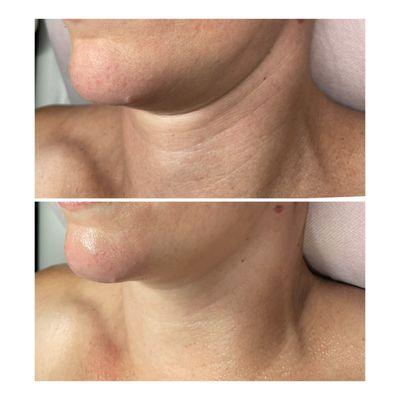 Custom microneedling combination with lots of fun modalities, here we aim for results, let us smooth out those pesky neck lines NATURALLY.