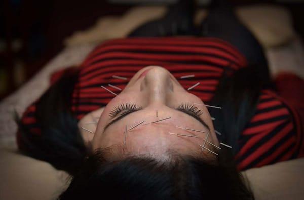 Go against gravity with an Acupuncture Facial