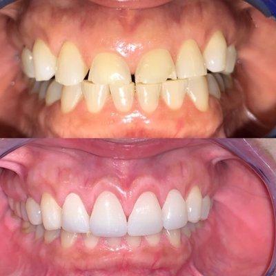 Before and After Front Crowns