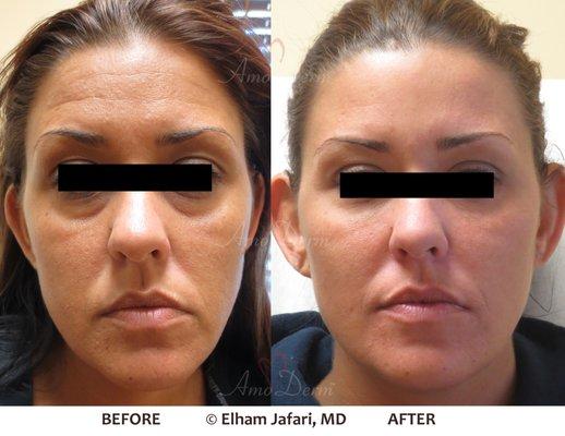 Liquid Facelift with combination of Botox/Dysport and filler injected in the temples, under the eyes, cheeks, and forehead.(Voluma/Volbella)