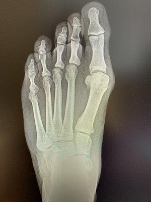 Bunion before surgery