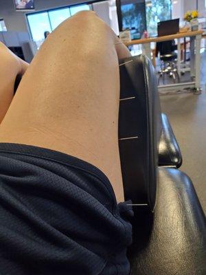 Dry needling for my runners knee