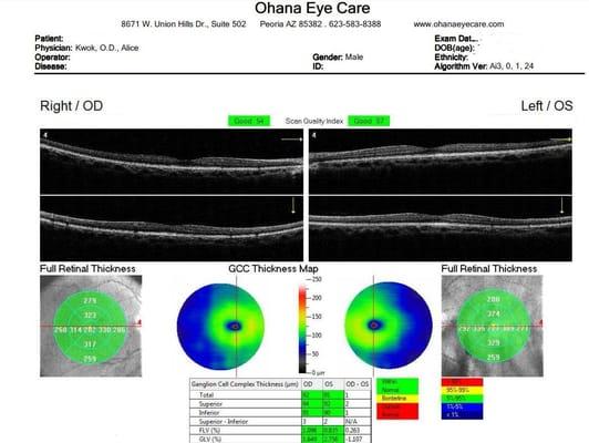 OCT 3D scanning of your eyes