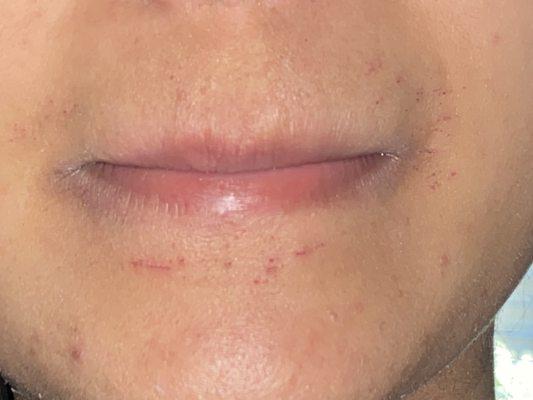 These are the scratches on my chin and lip area caused by the threading this week.