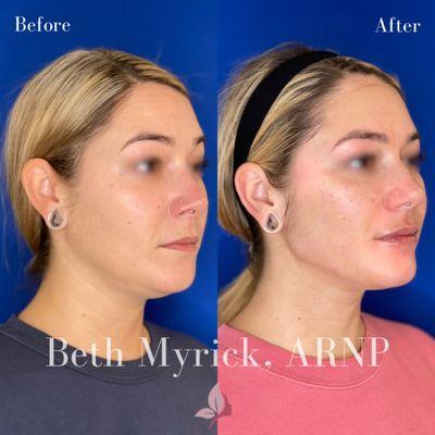 Full face filler