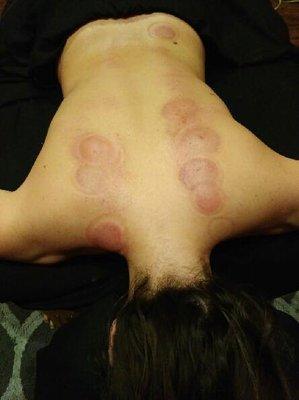 Cupping Therapy Offered Here