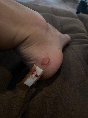 My pedicure cheese grater wound