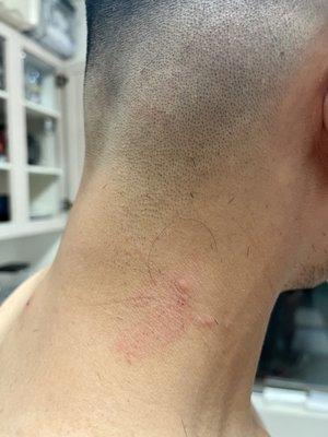 Nasty neck wound after the haircut.