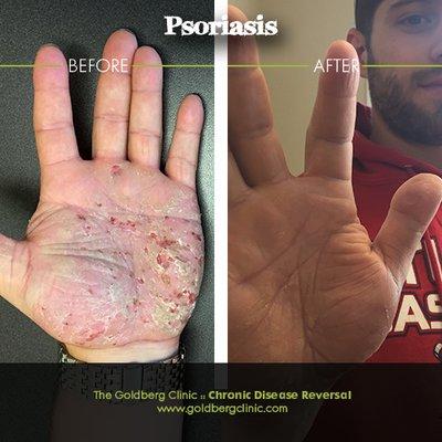 Psoriasis Before and After