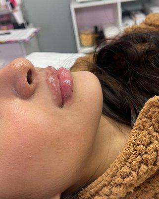 Hyaluron lip filler