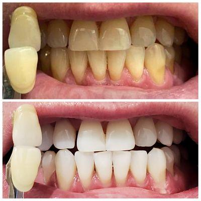 Amazing, real results with KOR Deep Bleaching. 2 weeks at home whitening + 1 hour in office whitening.