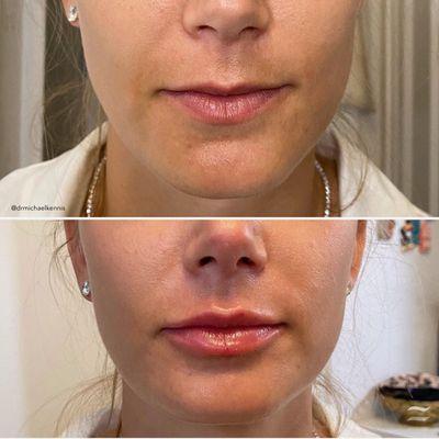 Lip Filler results by Dr. Michael Kennis