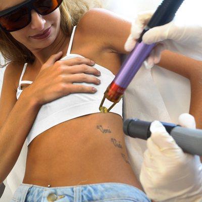 Laser Tattoo Removal For Women