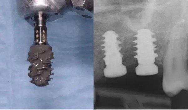 Straumann BLX Dental Implant