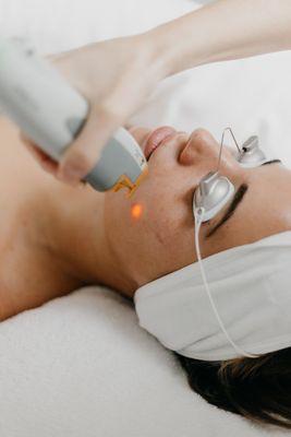 Laser Genesis , Great for acne , smoothing out skin tone, tightening, collagen stimulation