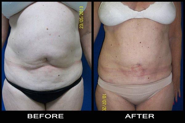 Liposuction