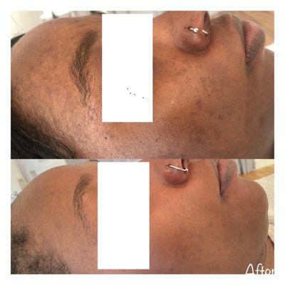 Glycolic Chemical Peel Results