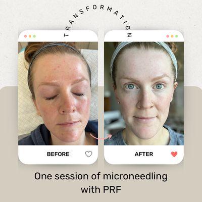 Microneedling with PRF