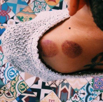 Client photo of cupping marks. She's feeling much better!