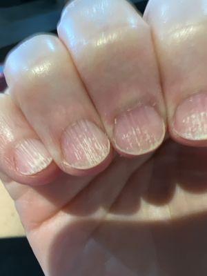 Damaged nails after manicure