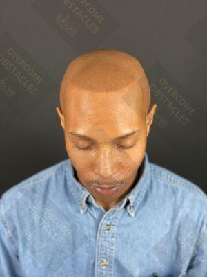 Best Scalp Micropigmentation Texas