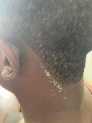 Bumps, and nastiness from razors, please pay attention to people barbers.