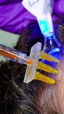 Platelet-Rich Fibrin for Hair Loss Treatment