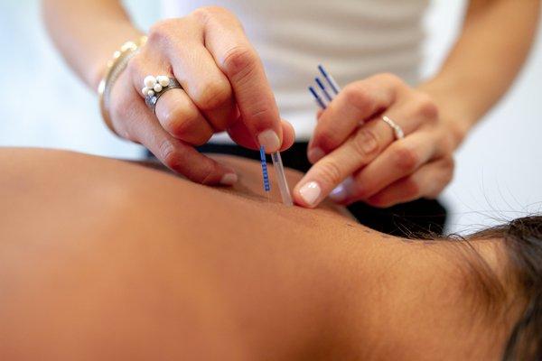 Acupuncture in San Diego