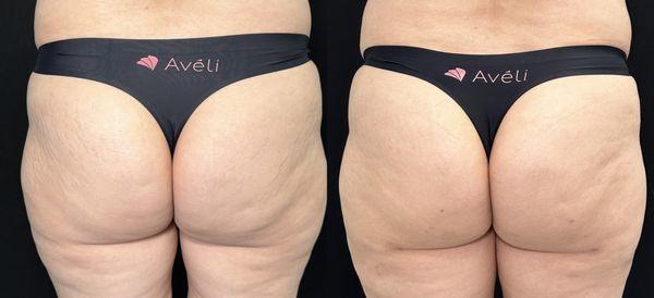 Aveli Cellulite Treatment 
Before and After