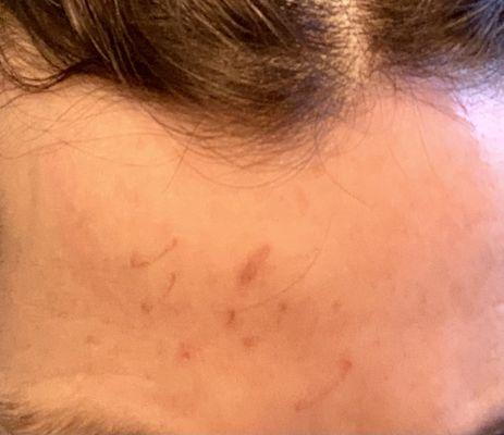 Burn scabs on my forehead from incompetent us of IPL by Dr. Eros