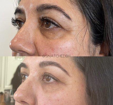 PRP AND MORPHEUS8 EYE REJUVENATION