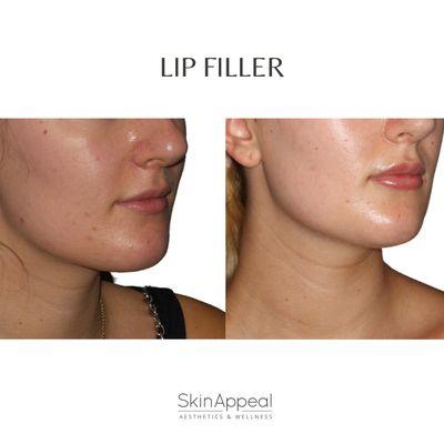 Lip Filler