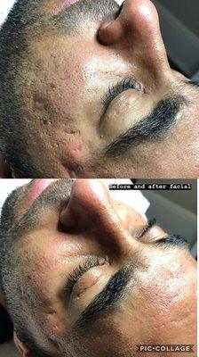 Before and after microdermabrasion facial