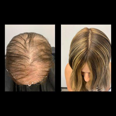 CNC scalp prosthetic on a client with androgenetic alopecia.