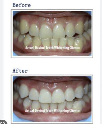 DaVinci Teeth
Whitening