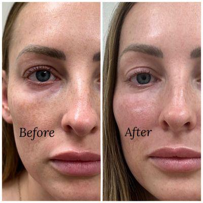 Facial balancing and rejuvenation for a more youthful appearance with facial filler in Kaysville, Utah.