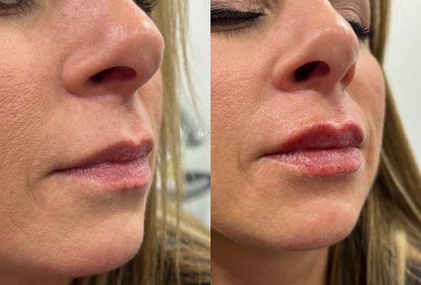 restylane defyne lip filler