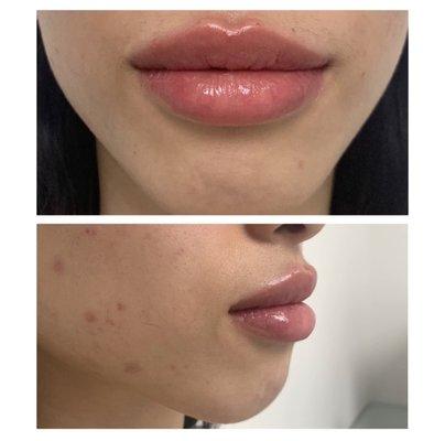 After Lip Augmentation using Juvederm Ultra Plus XC