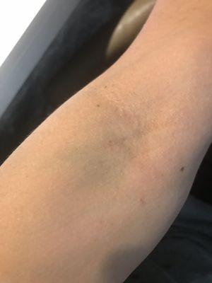 My sons arm. She refused to use a butterfly. Lied about not having any. Butchered him, moving the needle in and out, bruising him.