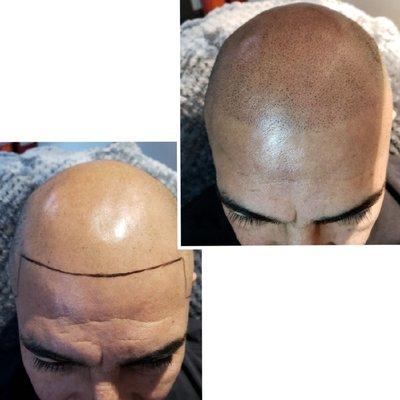 Before and After SMP (scalp micropigmentation)