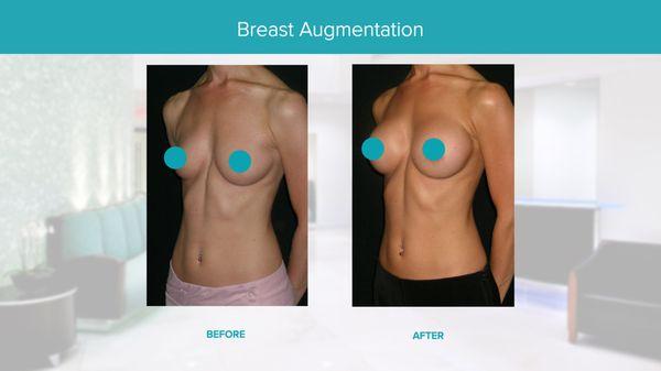 Real Results Before & After-Breast Augmentation