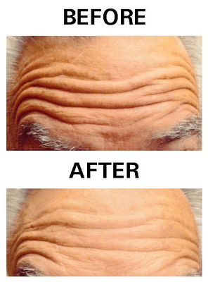 Before & After (treatment by Nicolle Skarmas, PA-C)