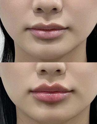 Lip Filler