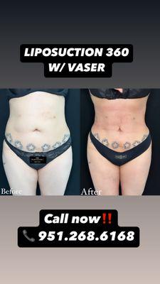 Liposuction 360 with Vaser. Before and After