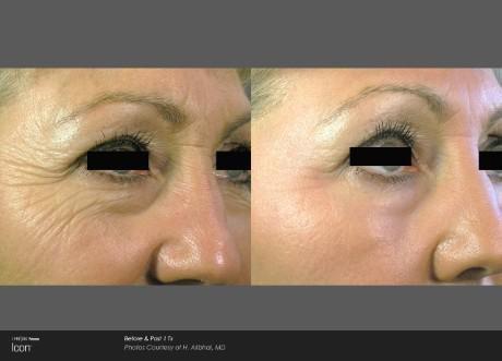 Wrinkle Reduction