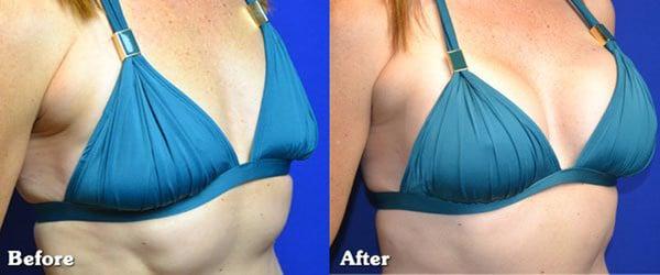 Breast Augmentation - Before & After