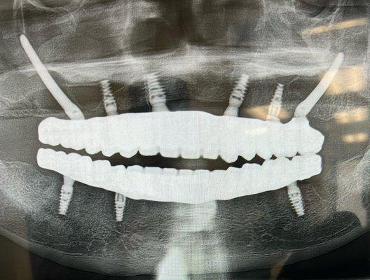 Teeth in a day. Zygoma implants! Happy patient! Another one