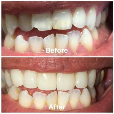 Before and After Dr. Davari magically fixed my teeth!