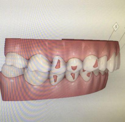 Before--( The computer simulation based on my teeth scanning)   My front top teeth stick out far away from bottom teeth