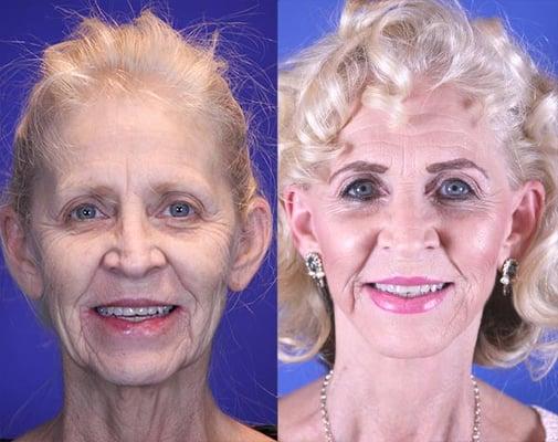 At 67 Wanda came to Youthful Reflections to remove the wrinkles  around her mouth and sagging in her neck.